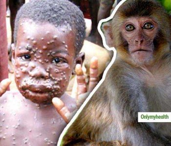 What is monkeypox, its symptoms and threat to you?