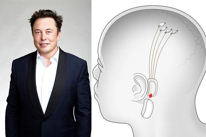 Elon Musk’s Neuralink implants brain chip in first human